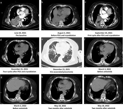 Significant response of pulmonary sarcomatoid carcinoma with obstructive atelectasis to treatment with the PD-1 inhibitor camrelizumab combined with transbronchial cryoablation: A case report and literature review
